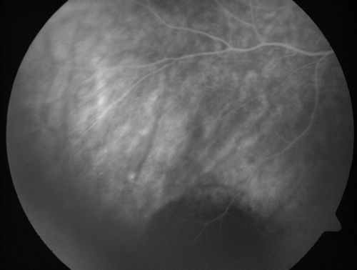 Eccentric Disciform Scar - Breakthrough Vitreous Hemorrhage - InferoTemporal Subretinal Fibrosis - Ectopic Choroidal Neovascular Membranes
88-year-old man has noticed for the last few months the vision in the right eye is foggy, like there is a film in the eye or a haze,  His vision is 20/16 in each eye. 
Right eye - inferotemporal periphery there is a hemorrhage at the equator at about 7:00 oâ€™clock, which is about 4-disc diameters across and adjacent to that there is scarring.
Left eye - large disciform scar inferotemporally

