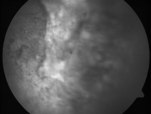 Eccentric Disciform Scar - Breakthrough Vitreous Hemorrhage - InferoTemporal Subretinal Fibrosis - Ectopic Choroidal Neovascular Membranes
88-year-old man has noticed for the last few months the vision in the right eye is foggy, like there is a film in the eye or a haze,  His vision is 20/16 in each eye. 
Right eye - inferotemporal periphery there is a hemorrhage at the equator at about 7:00 oâ€™clock, which is about 4-disc diameters across and adjacent to that there is scarring.
Left eye - large disciform scar inferotemporally
