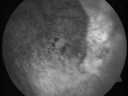 Eccentric Disciform Scar - Breakthrough Vitreous Hemorrhage - InferoTemporal Subretinal Fibrosis - Ectopic Choroidal Neovascular Membranes
88-year-old man has noticed for the last few months the vision in the right eye is foggy, like there is a film in the eye or a haze,  His vision is 20/16 in each eye. 
Right eye - inferotemporal periphery there is a hemorrhage at the equator at about 7:00 oâ€™clock, which is about 4-disc diameters across and adjacent to that there is scarring.
Left eye - large disciform scar inferotemporally
