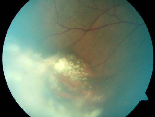 ECTOPIC DISCIFORM SCAR/PERIPHERAL CHOROIDAL NEOVASCULAR MEMBRANE â€“ EXUDATE â€“INFLAMMATION IN REACTION TO THE PERIPHERAL VASCULAR LESION 
53-year-old woman has noticed some blurred vision in the right eye for a few years.  In retrospect, she thinks it is possible since she was a teenager the right eye was always the weaker eye and that the left eye has always been the better eye.  VISUAL ACUITY:  Vision OD is 20/400
