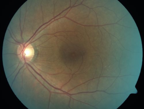 ECTOPIC DISCIFORM SCAR/PERIPHERAL CHOROIDAL NEOVASCULAR MEMBRANE â€“ EXUDATE â€“INFLAMMATION IN REACTION TO THE PERIPHERAL VASCULAR LESION 
53-year-old woman has noticed some blurred vision in the right eye for a few years.  In retrospect, she thinks it is possible since she was a teenager the right eye was always the weaker eye and that the left eye has always been the better eye.  VISUAL ACUITY:  Vision OD is 20/400

