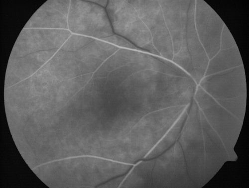 ECTOPIC DISCIFORM SCAR/PERIPHERAL CHOROIDAL NEOVASCULAR MEMBRANE â€“ EXUDATE â€“INFLAMMATION IN REACTION TO THE PERIPHERAL VASCULAR LESION 
53-year-old woman has noticed some blurred vision in the right eye for a few years.  In retrospect, she thinks it is possible since she was a teenager the right eye was always the weaker eye and that the left eye has always been the better eye.  VISUAL ACUITY:  Vision OD is 20/400
