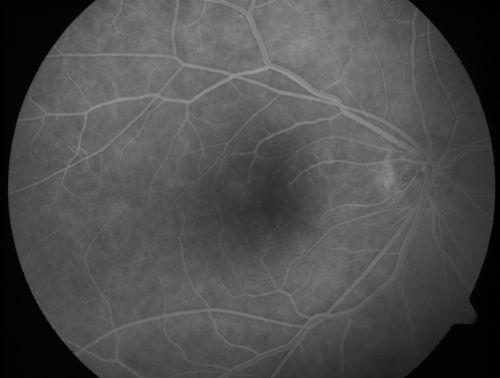 ECTOPIC DISCIFORM SCAR/PERIPHERAL CHOROIDAL NEOVASCULAR MEMBRANE â€“ EXUDATE â€“INFLAMMATION IN REACTION TO THE PERIPHERAL VASCULAR LESION 
53-year-old woman has noticed some blurred vision in the right eye for a few years.  In retrospect, she thinks it is possible since she was a teenager the right eye was always the weaker eye and that the left eye has always been the better eye.  VISUAL ACUITY:  Vision OD is 20/400
