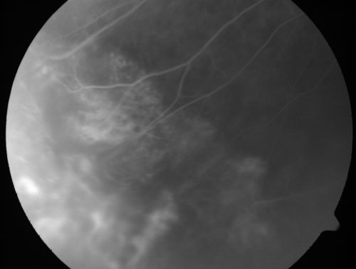ECTOPIC DISCIFORM SCAR/PERIPHERAL CHOROIDAL NEOVASCULAR MEMBRANE â€“ EXUDATE â€“INFLAMMATION IN REACTION TO THE PERIPHERAL VASCULAR LESION 
53-year-old woman has noticed some blurred vision in the right eye for a few years.  In retrospect, she thinks it is possible since she was a teenager the right eye was always the weaker eye and that the left eye has always been the better eye.  VISUAL ACUITY:  Vision OD is 20/400
