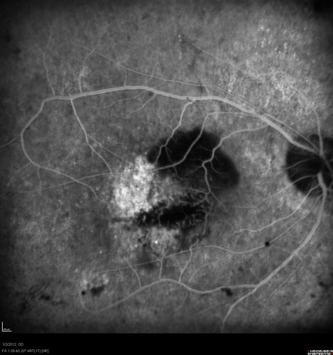 Post-Retinal Detachment Repair Occult Subfoveal CNVM
This pleasant 56-year-old man has had a complex retinal detachment repair in the right eye.  I most recently removed his silicone oil 3 months ago.  His vision now is the best it has ever been. 
VISUAL ACUITY:  OD 4/200
