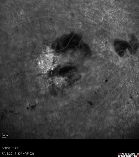 Post-Retinal Detachment Repair Occult Subfoveal CNVM
This pleasant 56-year-old man has had a complex retinal detachment repair in the right eye.  I most recently removed his silicone oil 3 months ago.  His vision now is the best it has ever been. 
VISUAL ACUITY:  OD 4/200
