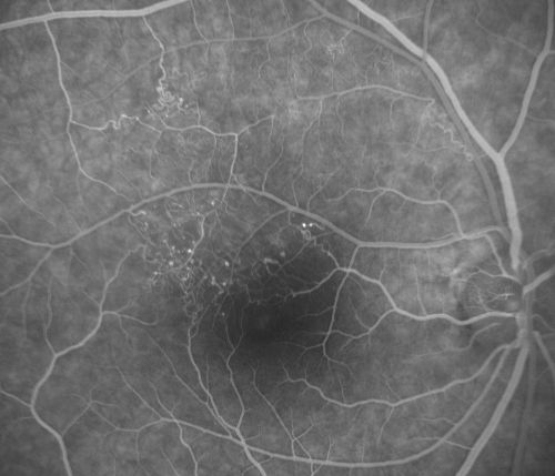 BRVO with collaterals and cystoid macular edema
66 Year Old Man with has had a branch retinal vein occlusion in the right eye with vision loss for the last few months.  OD is 20/40, OS is 20/20.  IOP:  OD 18, OS 19.  There is a superotemporal macular branch retinal vein occlusion with edema, hemorrhage, and exudate.
OCT SCAN:  The right eye shows edema with a central foveal thickness of 354 microns FA: shows remodeling of the superotemporal vasculature.  There are already venous-venous collaterals, suggesting the vein occlusion may be a little more than a few months old.  There are multiple microaneurysms superotemporal to the fovea, and there is leakage in the late frames involving the fovea.

Keywords: brvo;cme;cystoid macular edema;collaterals