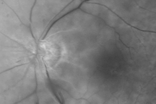 Central Retinal Artery Occlusion Left Eye 2 Weeks Old - Still Non-Perfusion
85-year-old woman who had sudden severevision loss in the left eye two weeks ago.   she can see a little more centrally and much more in the periphery, since about the last four days. 

VISUAL ACUITY:  OD 20/30,  OS: Hand motion
Keywords: cherry red spot;retinal edema;crao