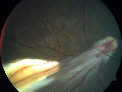 Familial Exudative Vitreoretinopathy - FEVR - Stage 4b OD
10 year old child with poor vision OD from birth.  The left eye had vascular remodelling in the temporal periphery with preretinal abnormalitlies seen on OCT.  The patient never returned for a fluorescein angiogram.  Left eye is either stage 1 or stage 2. no family history
