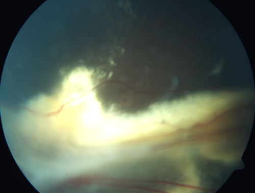 Familial Exudative Vitreoretinopathy - FEVR - Stage 4b OD
10 year old child with poor vision OD from birth.  The left eye had vascular remodelling in the temporal periphery with preretinal abnormalitlies seen on OCT.  The patient never returned for a fluorescein angiogram.  Left eye is either stage 1 or stage 2. no family history
