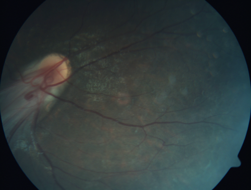 Familial Exudative Vitreoretinopathy - FEVR - Stage 4b OD
10 year old child with poor vision OD from birth.  The left eye had vascular remodelling in the temporal periphery with preretinal abnormalitlies seen on OCT.  The patient never returned for a fluorescein angiogram.  Left eye is either stage 1 or stage 2. no family history

