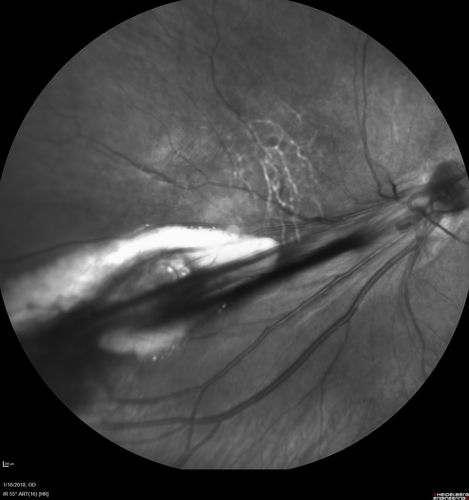 Familial Exudative Vitreoretinopathy - FEVR - Stage 4b OD
10 year old child with poor vision OD from birth.  The left eye had vascular remodelling in the temporal periphery with preretinal abnormalitlies seen on OCT.  The patient never returned for a fluorescein angiogram.  Left eye is either stage 1 or stage 2. no family history
