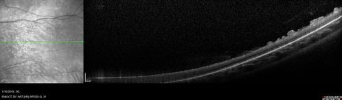 Familial Exudative Vitreoretinopathy - FEVR - Stage 4b OD
10 year old child with poor vision OD from birth.  The left eye had vascular remodelling in the temporal periphery with preretinal abnormalitlies seen on OCT.  The patient never returned for a fluorescein angiogram.  Left eye is either stage 1 or stage 2. no family history
