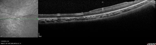 Familial Exudative Vitreoretinopathy - FEVR - Stage 4b OD
10 year old child with poor vision OD from birth.  The left eye had vascular remodelling in the temporal periphery with preretinal abnormalitlies seen on OCT.  The patient never returned for a fluorescein angiogram.  Left eye is either stage 1 or stage 2. no family history

