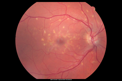 Fundus Flavimaculatus - Asymptomatic - Color Photo
45 year old man was told to come in because of â€˜white spots on their retinaâ€™.

