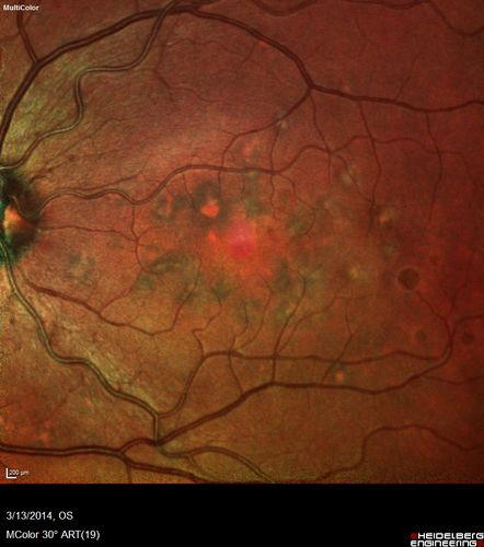 Fundus Flavimaculatus - Asymptomatic - Multi-Color (false color) Photo
45 year old man was told to come in because of â€˜white spots on their retinaâ€™.


