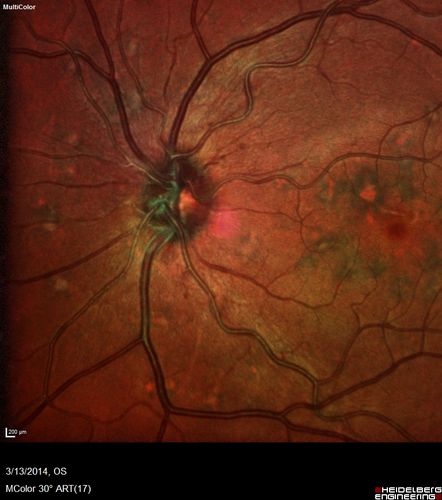 Fundus Flavimaculatus - Asymptomatic - Multi-Color (false color) Photo
45 year old man was told to come in because of â€˜white spots on their retinaâ€™.


