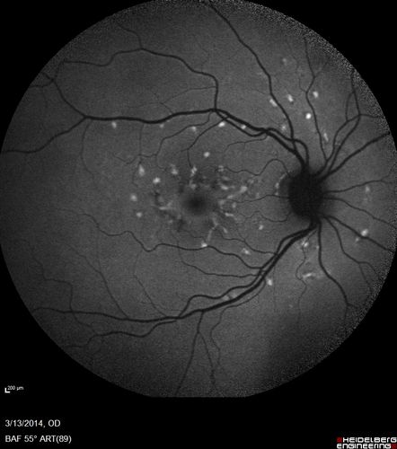 Fundus Flavimaculatus - Asymptomatic - Fundus Autofluorescence
45 year old man was told to come in because of â€˜white spots on their retinaâ€™. - FAF image shows that spots are strongly autofluorescent


