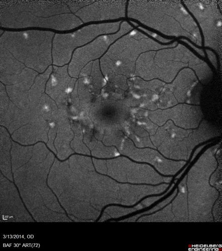 Fundus Flavimaculatus - Asymptomatic - Fundus Autofluorescence
45 year old man was told to come in because of â€˜white spots on their retinaâ€™. - FAF image shows that spots are strongly autofluorescent


