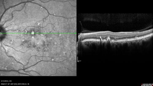 Fundus Flavimaculatus - Asymptomatic - Spectral Domain OCT Line Scan
45 year old man was told to come in because of â€˜white spots on their retinaâ€™.

