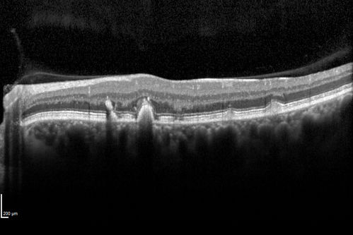 Fundus Flavimaculatus - Asymptomatic
45 year old man was told to come in because of â€˜white spots on their retinaâ€™.

