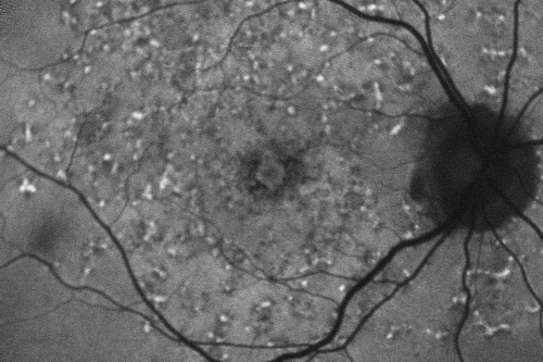 Fundus Flavimaculatus - Stargardt Disease - 20/50 OD 20/200 OS 61 Year old Fundus Autofluorescence od
61-year-old decreasing vision for about the last five years.  OD 20/50,  OS 20/200. 

Pisciform Lesions and Macular Atrophy
