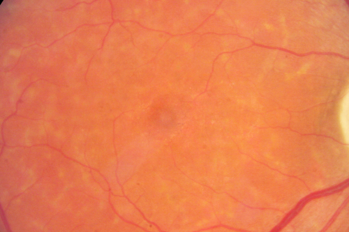 Fundus Flavimaculatus - Stargardt Disease - 20/50 OD 20/200 OS 61 Year old  Color Photo
61-year-old decreasing vision for about the last five years.  OD 20/50,  OS 20/200. 

Pisciform Lesions and Macular Atrophy
