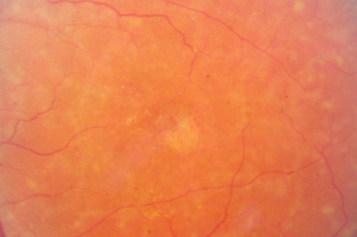 Fundus Flavimaculatus - Stargardt Disease - 20/50 OD 20/200 OS 61 Year old  Color Photo
61-year-old decreasing vision for about the last five years.  OD 20/50,  OS 20/200. 

Pisciform Lesions and Macular Atrophy
