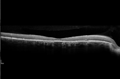 Fundus Flavimaculatus - Stargardt Disease - 20/50 OD 20/200 OS 61 Year old - SD OCT OD
61-year-old decreasing vision for about the last five years.  OD 20/50,  OS 20/200. 

Pisciform Lesions and Macular Atrophy
