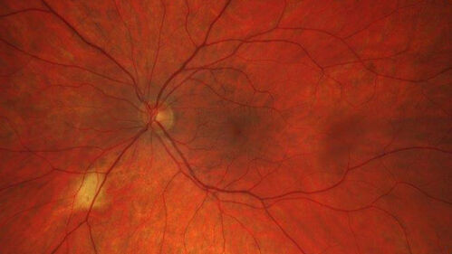 Focal Scleral Nodule
49 year old white female with recent mild trauma to the right eye and 20/20 vision in both eyes.  Left eye has a focal scleral nodule
