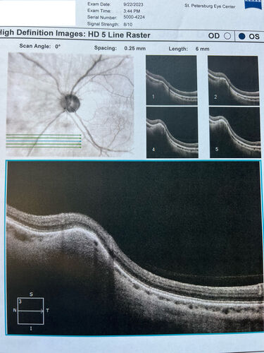 Focal Scleral Nodule
49 year old white female with recent mild trauma to the right eye and 20/20 vision in both eyes.  Left eye has a focal scleral nodule
