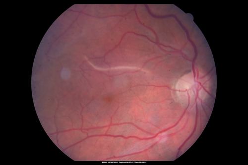 Retinal fold following removal of severe macular pucker
75 year old man had macula on inferior retinal detachment repair.  He then developed a 5/200 dense macular pucker.  After the pucker was removed the vision returned to 20/40 but there was a persistent superior retinal fold that looks a little like a snake.
