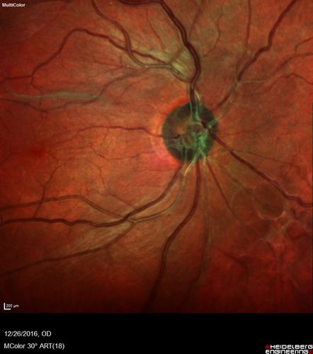 Retinal fold following removal of severe macular pucker
75 year old man had macula on inferior retinal detachment repair.  He then developed a 5/200 dense macular pucker.  After the pucker was removed the vision returned to 20/40 but there was a persistent superior retinal fold that looks a little like a snake.
