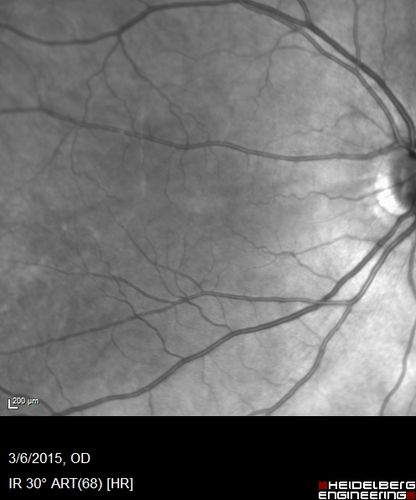 Foveal hypoplasia - aplasia
SD OCT shows persistent plexiform layers in the center of the macula 
EXTENDED HPI: He is having some trouble seeing his gadgets (like his watch). He was diagnosed with morning glory syndrome at about 3 yeras old. This last visit you saw fluid under the retina and asked him to come here. The vision is a little worse.
VA OD: Dcc20/40+2 NccJ2-2
VA OS: Dcc20/25-2 NccJ1-2
