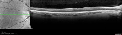 Foveal hypoplasia - aplasia
SD OCT shows persistent plexiform layers in the center of the macula 
EXTENDED HPI: He is having some trouble seeing his gadgets (like his watch). He was diagnosed with morning glory syndrome at about 3 yeras old. This last visit you saw fluid under the retina and asked him to come here. The vision is a little worse.
VA OD: Dcc20/40+2 NccJ2-2
VA OS: Dcc20/25-2 NccJ1-2
