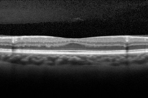 Foveal hypoplasia - aplasia
SD OCT shows persistent plexiform layers in the center of the macula 
EXTENDED HPI: He is having some trouble seeing his gadgets (like his watch). He was diagnosed with morning glory syndrome at about 3 yeras old. This last visit you saw fluid under the retina and asked him to come here. The vision is a little worse.
VA OD: Dcc20/40+2 NccJ2-2
VA OS: Dcc20/25-2 NccJ1-2
