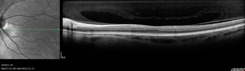 Foveal hypoplasia - aplasia
SD OCT shows persistent plexiform layers in the center of the macula 
EXTENDED HPI: He is having some trouble seeing his gadgets (like his watch). He was diagnosed with morning glory syndrome at about 3 yeras old. This last visit you saw fluid under the retina and asked him to come here. The vision is a little worse.
VA OD: Dcc20/40+2 NccJ2-2
VA OS: Dcc20/25-2 NccJ1-2
