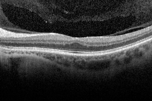 Foveal hypoplasia - aplasia
SD OCT shows persistent plexiform layers in the center of the macula 
EXTENDED HPI: He is having some trouble seeing his gadgets (like his watch). He was diagnosed with morning glory syndrome at about 3 yeras old. This last visit you saw fluid under the retina and asked him to come here. The vision is a little worse.
VA OD: Dcc20/40+2 NccJ2-2
VA OS: Dcc20/25-2 NccJ1-2
