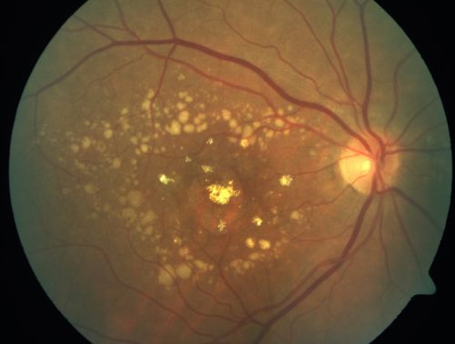 fovealgeographicatrophy_masw02.jpg