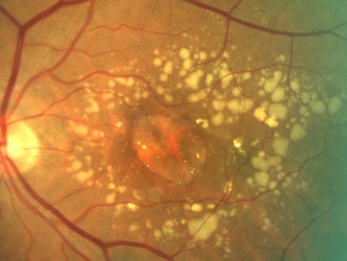 fovealgeographicatrophy_masw03.jpg