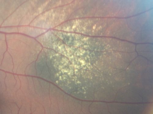 Choroidal Nevus with Overlying Drusen
48-year-old woman Vision OD is 20/16, OS is 20/20.
