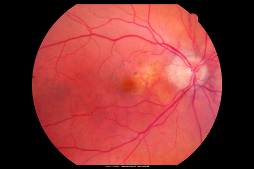 Angioid Streaks and Macular Degeneration - CNVM OS - Band Keratopathy 
79-year-old man has wet age-related macular degeneration in the left eye, for which he is having Lucentis treatment.    OD 20/40,  Pinhole 20/32.   OS 20/160, Pinhole 20/50.   He has band keratopathy sparing the visual axis in both eyes.  ICG shows angioid streaks both eye.
