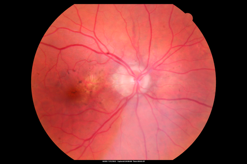 Angioid Streaks and Macular Degeneration - CNVM OS - Band Keratopathy 
79-year-old man has wet age-related macular degeneration in the left eye, for which he is having Lucentis treatment.    OD 20/40,  Pinhole 20/32.   OS 20/160, Pinhole 20/50.   He has band keratopathy sparing the visual axis in both eyes.  ICG shows angioid streaks both eye.
