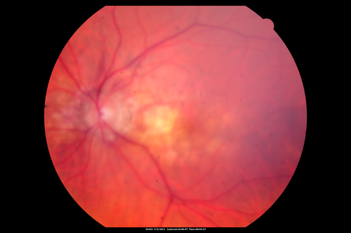 Angioid Streaks and Macular Degeneration - CNVM OS - Band Keratopathy 
79-year-old man has wet age-related macular degeneration in the left eye, for which he is having Lucentis treatment.    OD 20/40,  Pinhole 20/32.   OS 20/160, Pinhole 20/50.   He has band keratopathy sparing the visual axis in both eyes.  ICG shows angioid streaks both eye.
