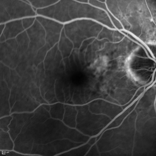 Angioid Streaks and Macular Degeneration - CNVM OS - Band Keratopathy 
79-year-old man has wet age-related macular degeneration in the left eye, for which he is having Lucentis treatment.    OD 20/40,  Pinhole 20/32.   OS 20/160, Pinhole 20/50.   He has band keratopathy sparing the visual axis in both eyes.  ICG shows angioid streaks both eye.
