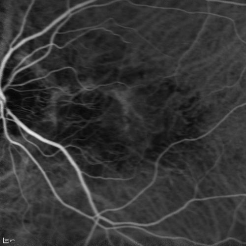 Angioid Streaks and Macular Degeneration - CNVM OS - Band Keratopathy 
79-year-old man has wet age-related macular degeneration in the left eye, for which he is having Lucentis treatment.    OD 20/40,  Pinhole 20/32.   OS 20/160, Pinhole 20/50.   He has band keratopathy sparing the visual axis in both eyes.  ICG shows angioid streaks both eye.
