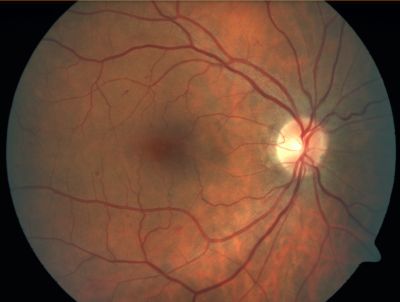 Retinal Vasculopathy associated with Facioscapulohumeral Muscular Dystrophy 
59-year-old woman had a blood pressure spike to 170/90 and was on medications for that. She does have facioscapulohumeral muscular dystrophy, which runs in her family. She has a cousin with the same disorder.
VISUAL ACUITY: Her vision is 20/25 OU. IOP: OD 21, OS 18.
There is no posterior vitreous separation, telangiectatic vessels near the macula. There are patchy retinal hemorrhages. There is no edema or proliferation.
59-year-old woman had a blood pressure spike to 170/90 and was on medications for tha
Keywords: diabetic like; systemic disease; vasculopathy; hemorrhage; bdr