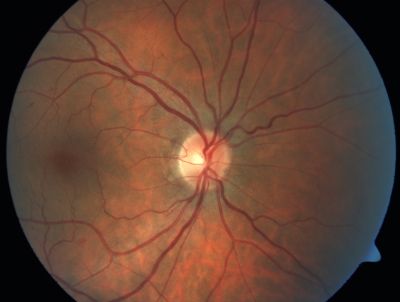 Retinal Vasculopathy associated with Facioscapulohumeral Muscular Dystrophy 
59-year-old woman had a blood pressure spike to 170/90 and was on medications for that. She does have facioscapulohumeral muscular dystrophy, which runs in her family. She has a cousin with the same disorder.
VISUAL ACUITY: Her vision is 20/25 OU. IOP: OD 21, OS 18.
There is no posterior vitreous separation, telangiectatic vessels near the macula. There are patchy retinal hemorrhages. There is no edema or proliferation.

Võtmesõnad: diabetic like; systemic disease; vasculopathy; hemorrhage; bdr