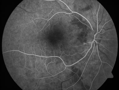 Retinal Vasculopathy associated with Facioscapulohumeral Muscular Dystrophy very early fa
59-year-old woman had a blood pressure spike to 170/90 and was on medications for that. She does have facioscapulohumeral muscular dystrophy, which runs in her family. She has a cousin with the same disorder.
VISUAL ACUITY: Her vision is 20/25 OU. IOP: OD 21, OS 18.
There is no posterior vitreous separation, telangiectatic vessels near the macula. There are patchy retinal hemorrhages. There is no edema or proliferation.

Palabras clave: diabetic like; systemic disease; vasculopathy; hemorrhage; bdr