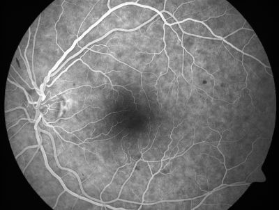 Retinal Vasculopathy associated with Facioscapulohumeral Muscular Dystrophy early fa
59-year-old woman had a blood pressure spike to 170/90 and was on medications for that. She does have facioscapulohumeral muscular dystrophy, which runs in her family. She has a cousin with the same disorder.
VISUAL ACUITY: Her vision is 20/25 OU. IOP: OD 21, OS 18.
There is no posterior vitreous separation, telangiectatic vessels near the macula. There are patchy retinal hemorrhages. There is no edema or proliferation.

Võtmesõnad: diabetic like; systemic disease; vasculopathy; hemorrhage; bdr